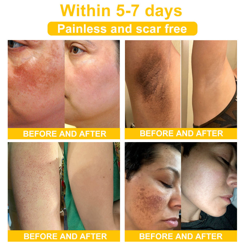 LOVILDS™ BEE POISON Skin Cream(👨⚕AAD Recommended),for Remove Warts, Acne and Scars