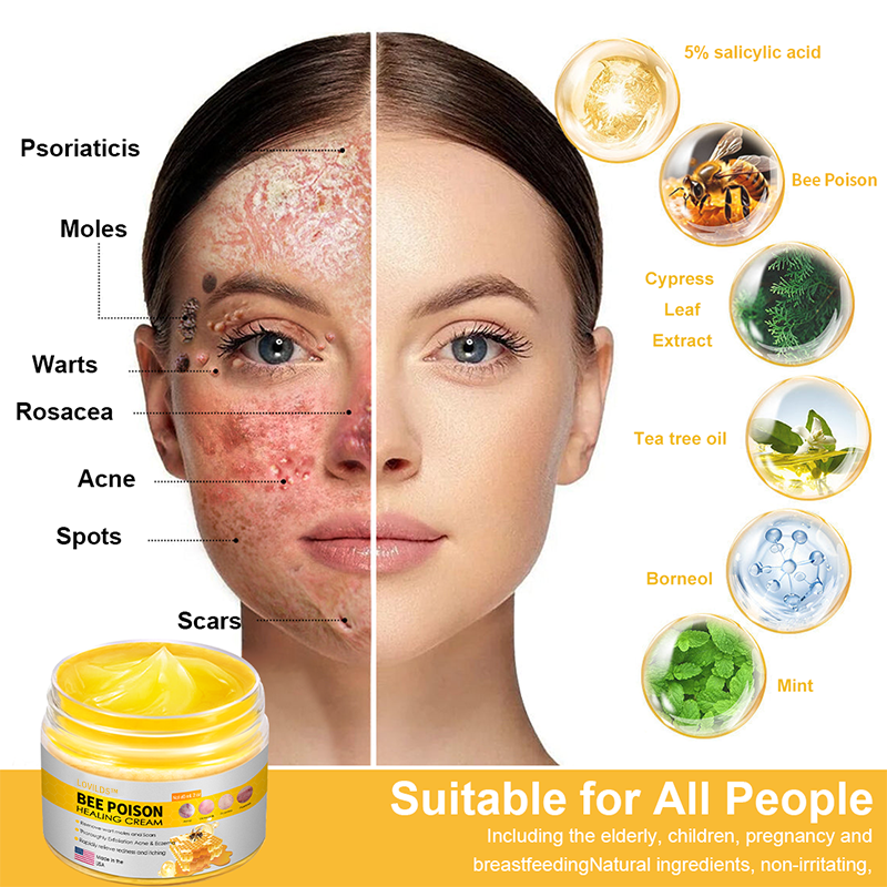 LOVILDS™ BEE POISON Skin Cream(👨⚕AAD Recommended),for Remove Warts, Acne and Scars