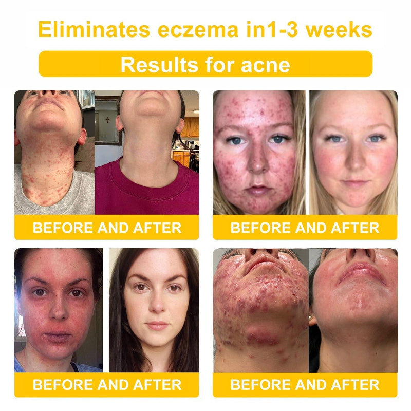 LOVILDS™ BEE POISON Skin Cream(👨⚕AAD Recommended),for Remove Warts, Acne and Scars