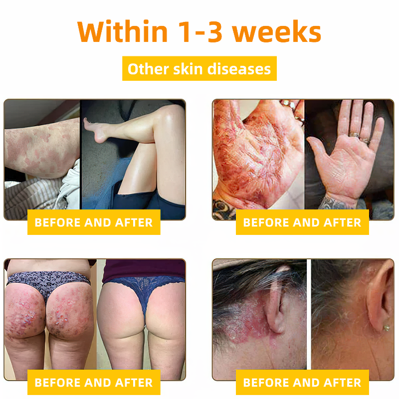 LOVILDS™ BEE POISON Skin Cream(👨⚕AAD Recommended),for Remove Warts, Acne and Scars