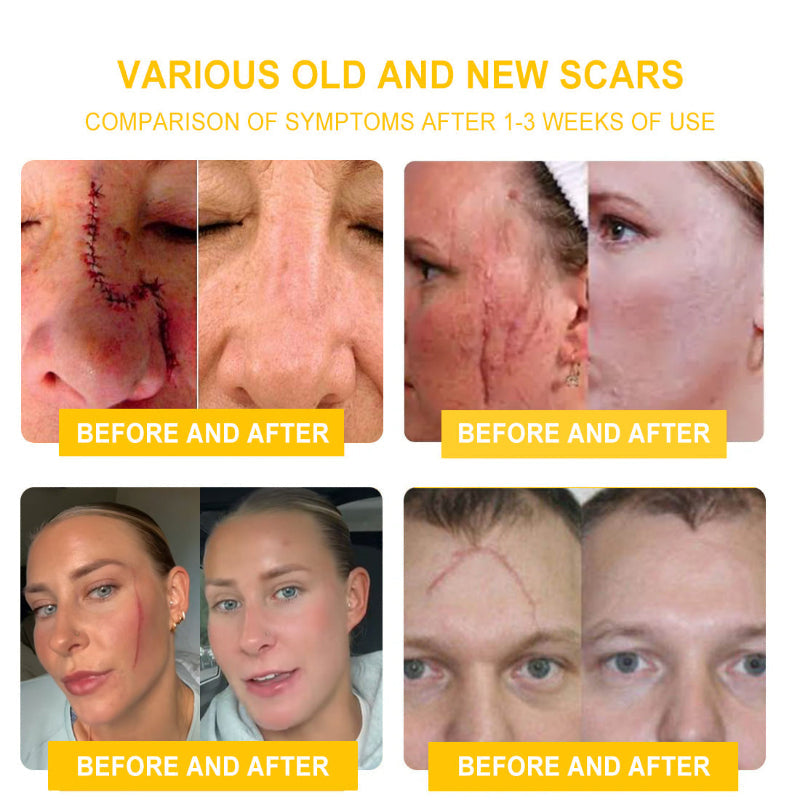 LOVILDS™ BEE POISON Skin Cream(👨⚕AAD Recommended),for Remove Warts, Acne and Scars