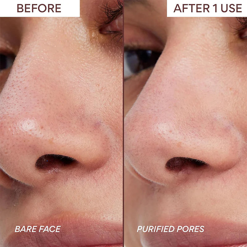 Vaxflite™ Nose Pore Patches for Pores & Pimples | Medical-Grade Hydrocolloid 🔥Maximum discount -50%🔥