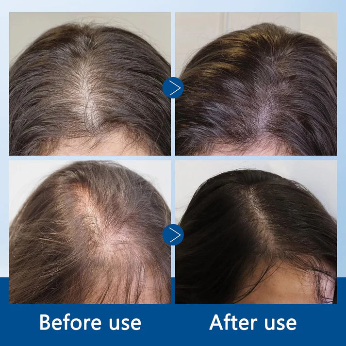 🔥 Vaxflite Hair Growth Roll-On Serum – See hair growth in 2 weeks(Keep using)🔥-Up to 75% off