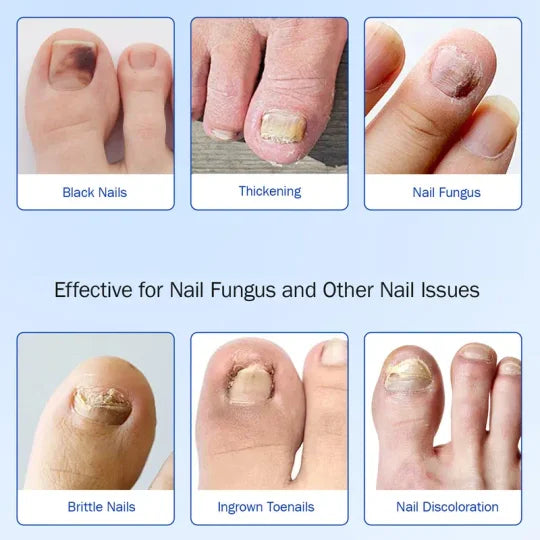 🔥Fungal Nail Patches, 21pcs/box Nail Health Care Patches, Nail Fungus Care Patches, Suitable for Solving Fungal Nails and Other Nail Problems, Nail Supplies, Daily Care Nails Kit Set - ⚡️Limited-time maximum discount of 70%⚡️