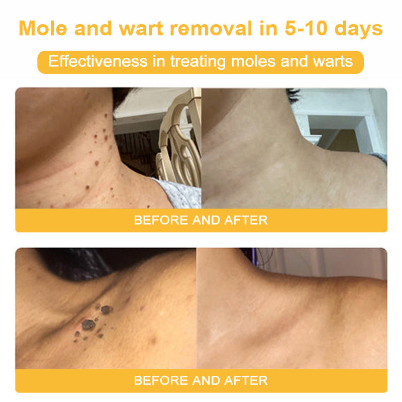 LOVILDS™ BEE POISON Skin Cream（👨‍⚕AAD Recommended),for Remove Warts, Acne and Scars