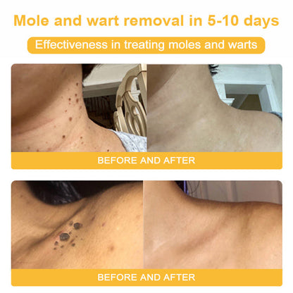 LOVILDS™ BEE POISON Skin Cream（👨‍⚕AAD Recommended),for Remove Warts, Acne and Scars
